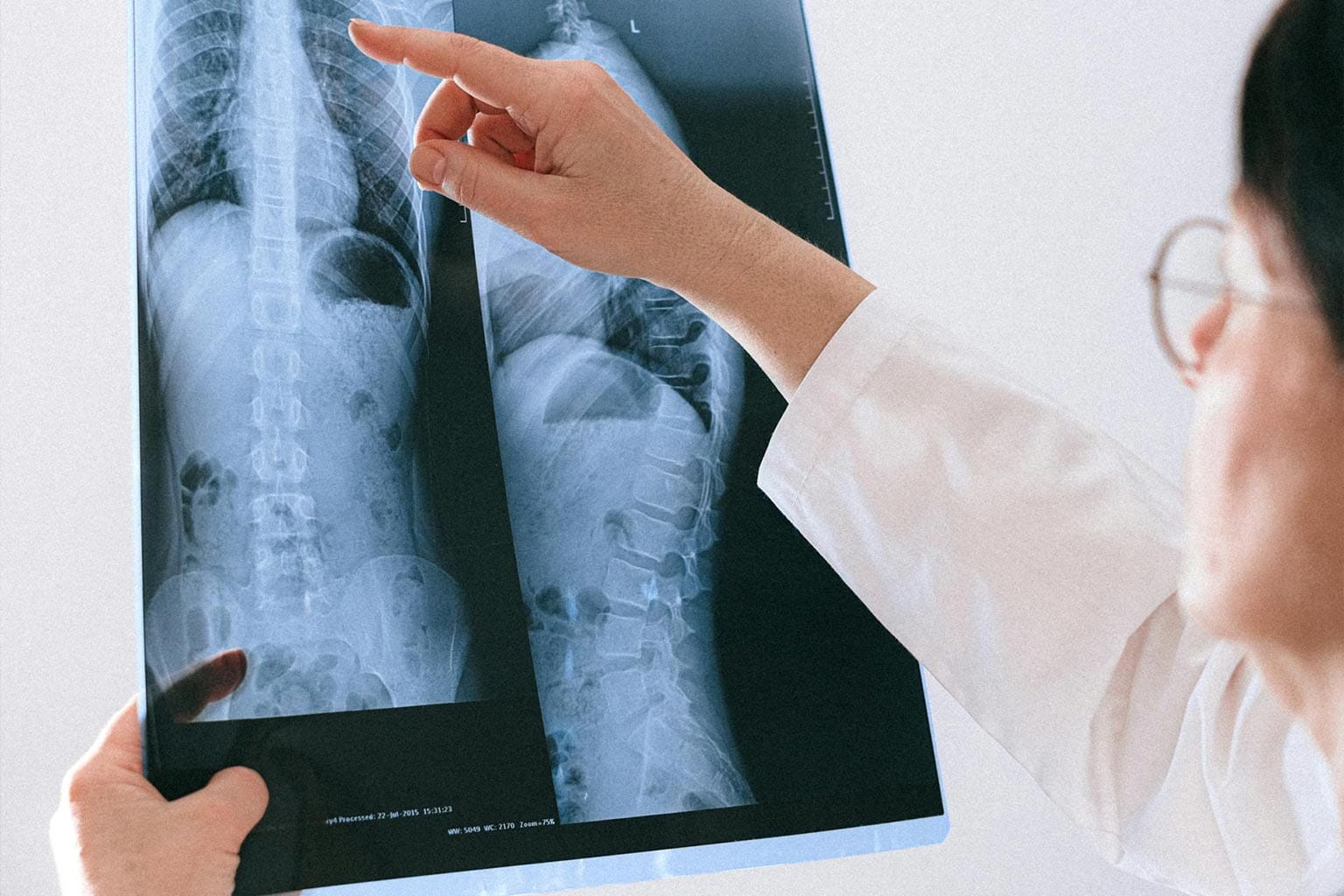 Zweitmeinung zur Wirbelsäule